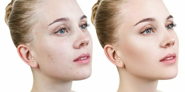 Vrouw Voor En Na Acne