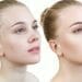 Vrouw Voor En Na Acne