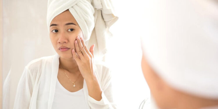 Acne Geneesmiddel