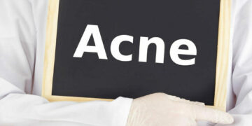 Feiten Over Acne