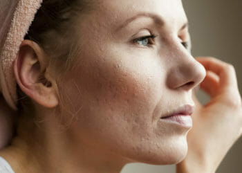 Acne Bij Volwassen Vrouw