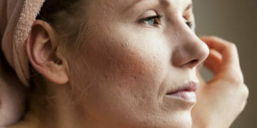 Acne Bij Volwassen Vrouw
