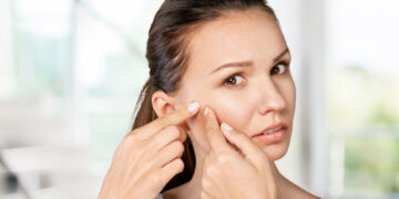 Acne En Uitknijpen Op Wang