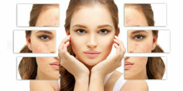 Acne Problemen Aanpakken