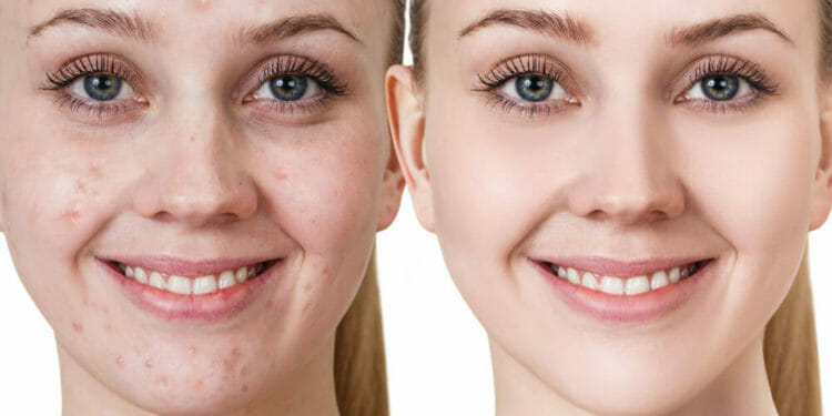 Vrouw Voor En Na Acne