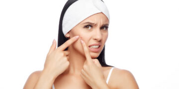 Hulp Tegen Acne